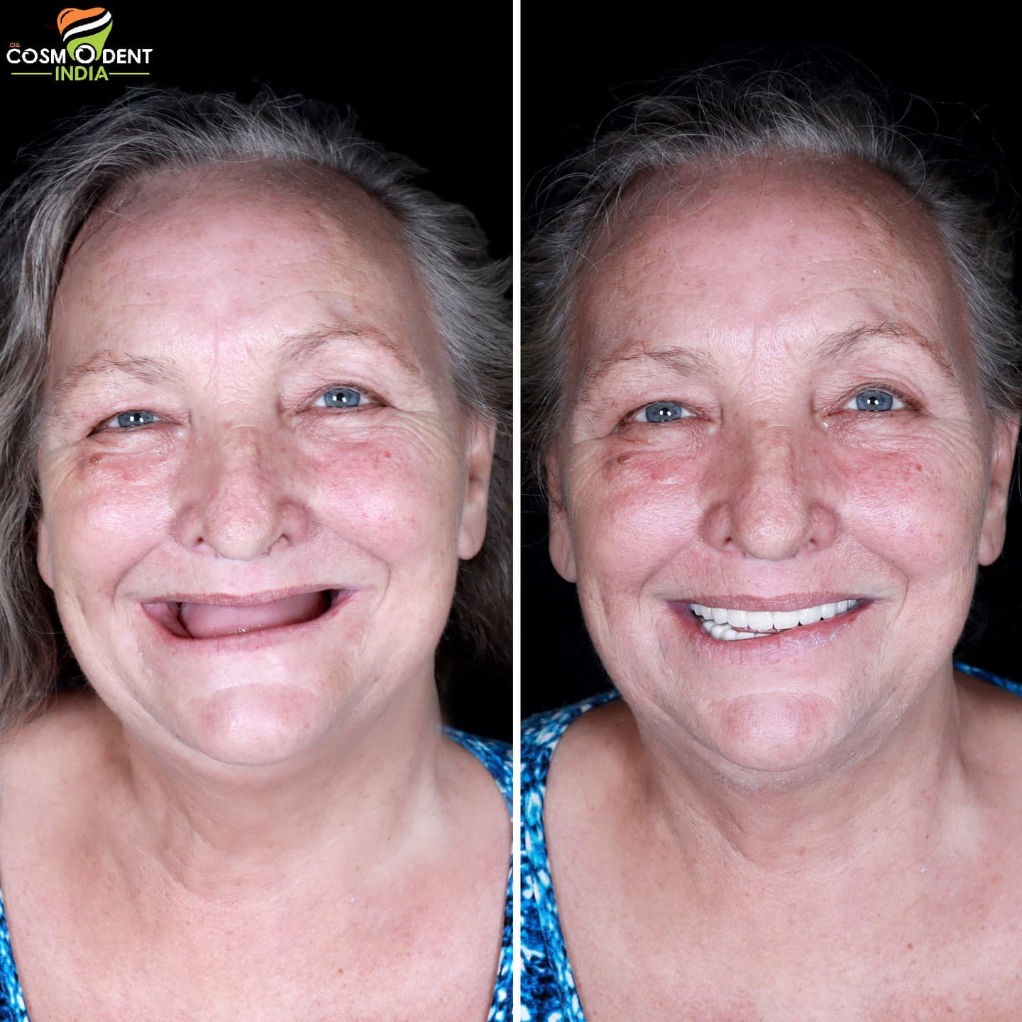 Patient smile transformation at Cosmodent India