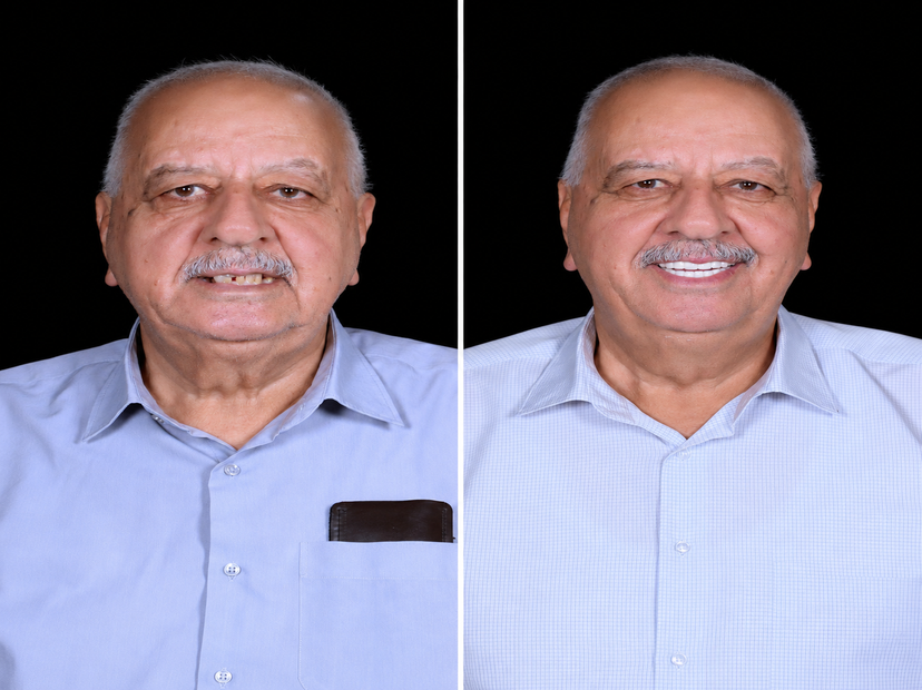 Cosmodent India before and after result 2
