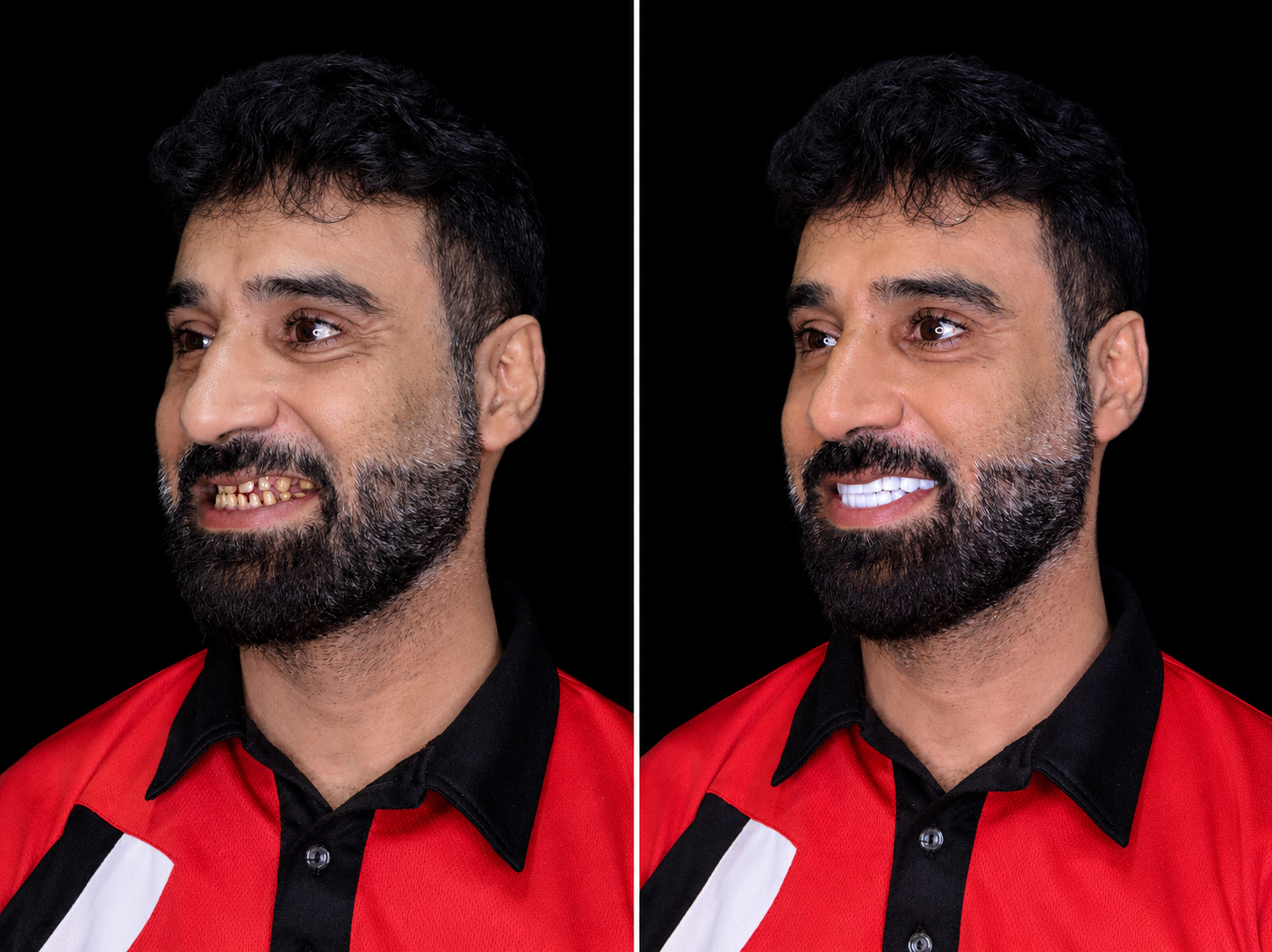 Cosmodent India before and after result 3